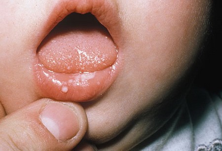 Thrush In Babies. If thrush has developed after