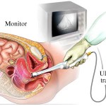 How To Read A Transvaginal Ultrasound