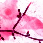 How to Treat Yeast Infections in People with Liver Disease