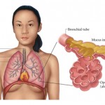 How to Avoid Pneumonia 