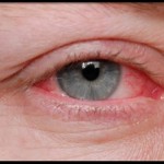 How to Treat Allergy