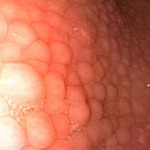 How to Treat Gastritis