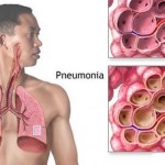 How to Treat Pneumonia