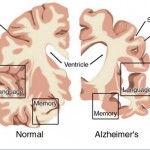 How to Keep Alzheimer's Disease From Striking You