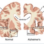 How to Treat Alzheimer's Disease