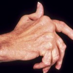 How to Control Arthritis