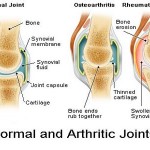 How to Treat Arthritis