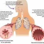 How to Treat Asthma 