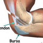 How to Treat Bursitis