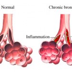 How to Treat Chronic Bronchitis
