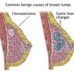 How to Treat Fibrocystic Breast Disease