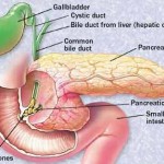 How to Treat Gallstones