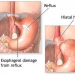 How to Treat Gastroesophageal Reflux Disease 