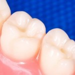 How to Treat Gingivitis