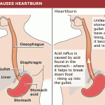 How to Stop Heartburn Forever