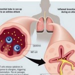 How to Manage Long-Standing Asthma