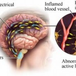 How to Treat Migraines