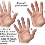 How to Treat Raynaud's Disease/Phenomenon