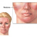 How to Treat Rosacea