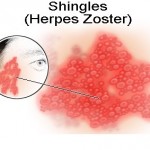 How to Treat Shingles 