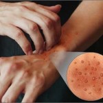 How to Stop Dermatitis Forever 