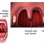 How to Treat Strep Throat 