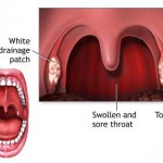 How to Treat Strep Throat