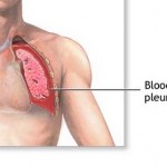 How to Treat Abscesses in Children