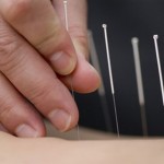 How to Use Acupuncture to Treat Various Illnesses