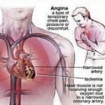 How to Cure Angina Pectoris with Drug Treatment