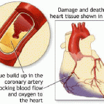 How to Cope with Coronary Heart Disease