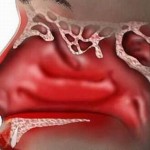 How to Treat Hayfever in Children (Allergic Rhinitis)