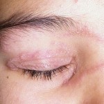 How to Treat Ringworm in Children