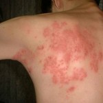 How to Treat Shingles in Children