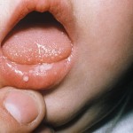 How to Treat Thrush in Children 