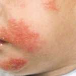 How to Treat Eczema in Children