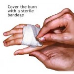 How to Treat Minor Burns and Scalds in Children