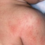 How to Treat Rash in Children 