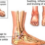 How to Treat Sprains in Children