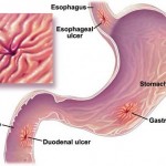 How to Treat Ulcers in Children