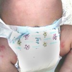 How to Treat Urticaria in Children