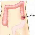 How to Care a Patient with a Stoma