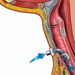 How to Care for a Tracheostomy Patient at Home