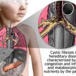 How to Treat Cystic Fibrosis