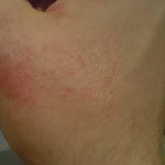 How to Cure Eczema