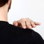 How to Cure Dandruff