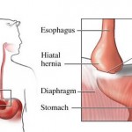 How to Treat Hiatal Hernias Naturally