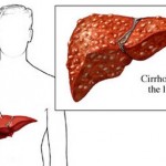 How to Identify Liver Symptoms