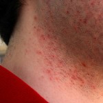 How to Prevent Razor Bumps