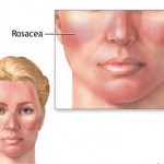 How to Treat Rosacea Naturally